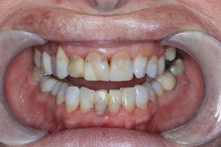before dental crowns