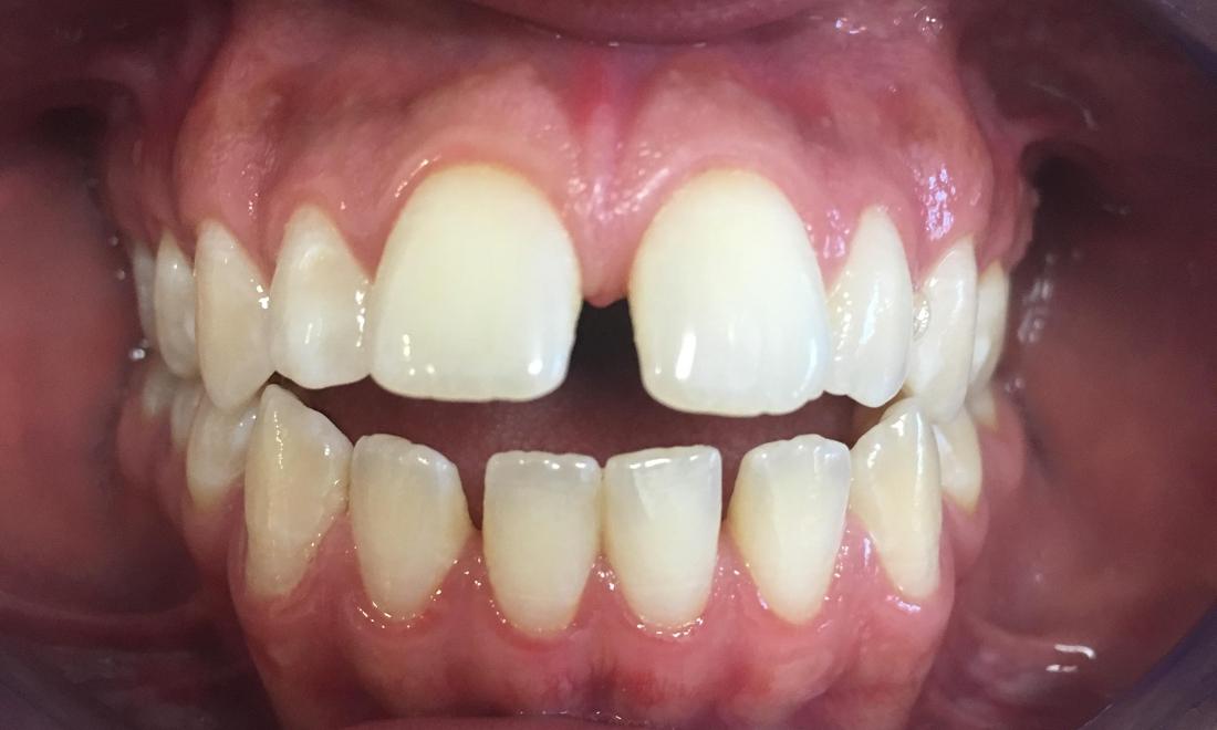 Braces and Invisalign - Before