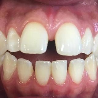 Braces and Invisalign - Before