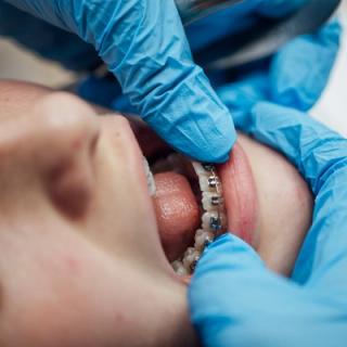 Image of a dentist fixing the orthodontic braces of a patient.