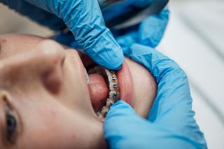 Metal Braces
