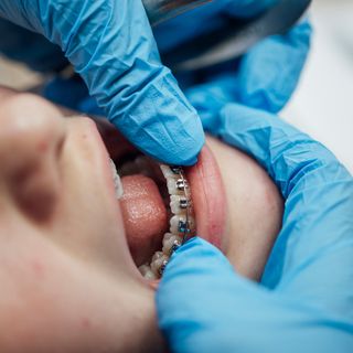 Fixed metal braces