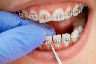 Metal Braces