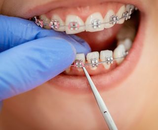 How Much Do Braces Cost?