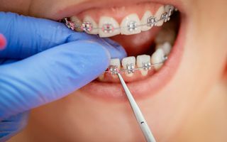 Braces are great for teenagers to get nice teeth for the future.