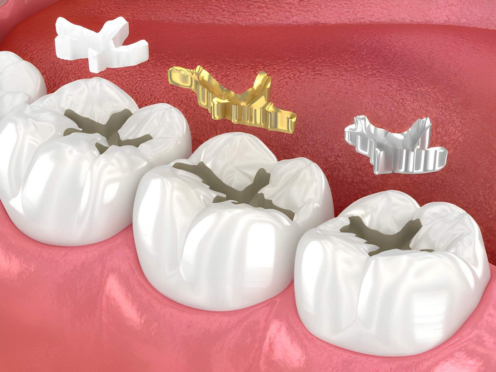 What Are Dental Fillings?
