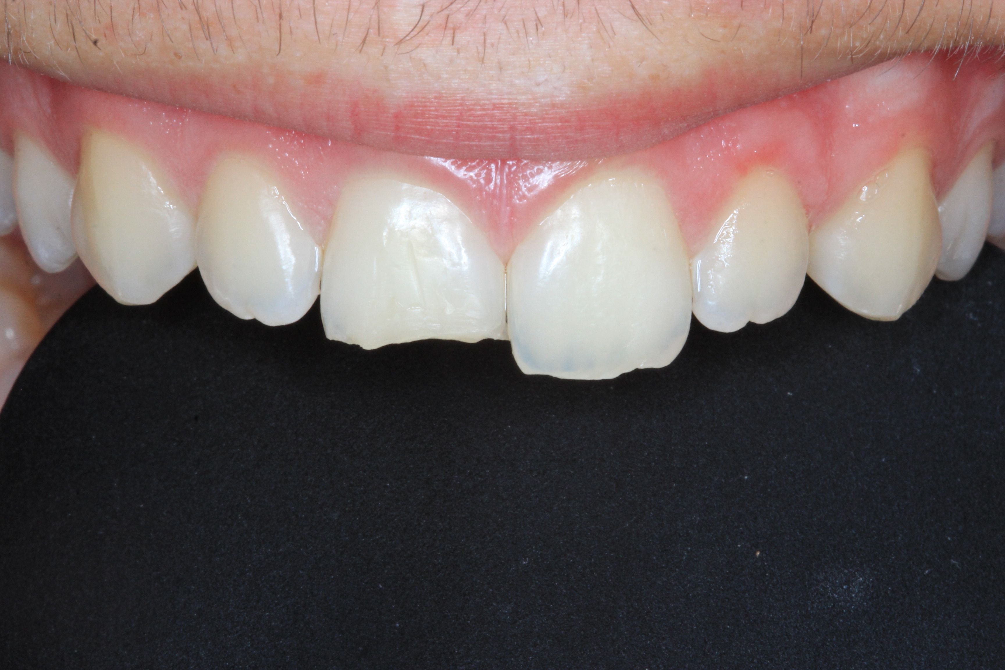 Front Tooth Filling