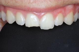Front Tooth Filling