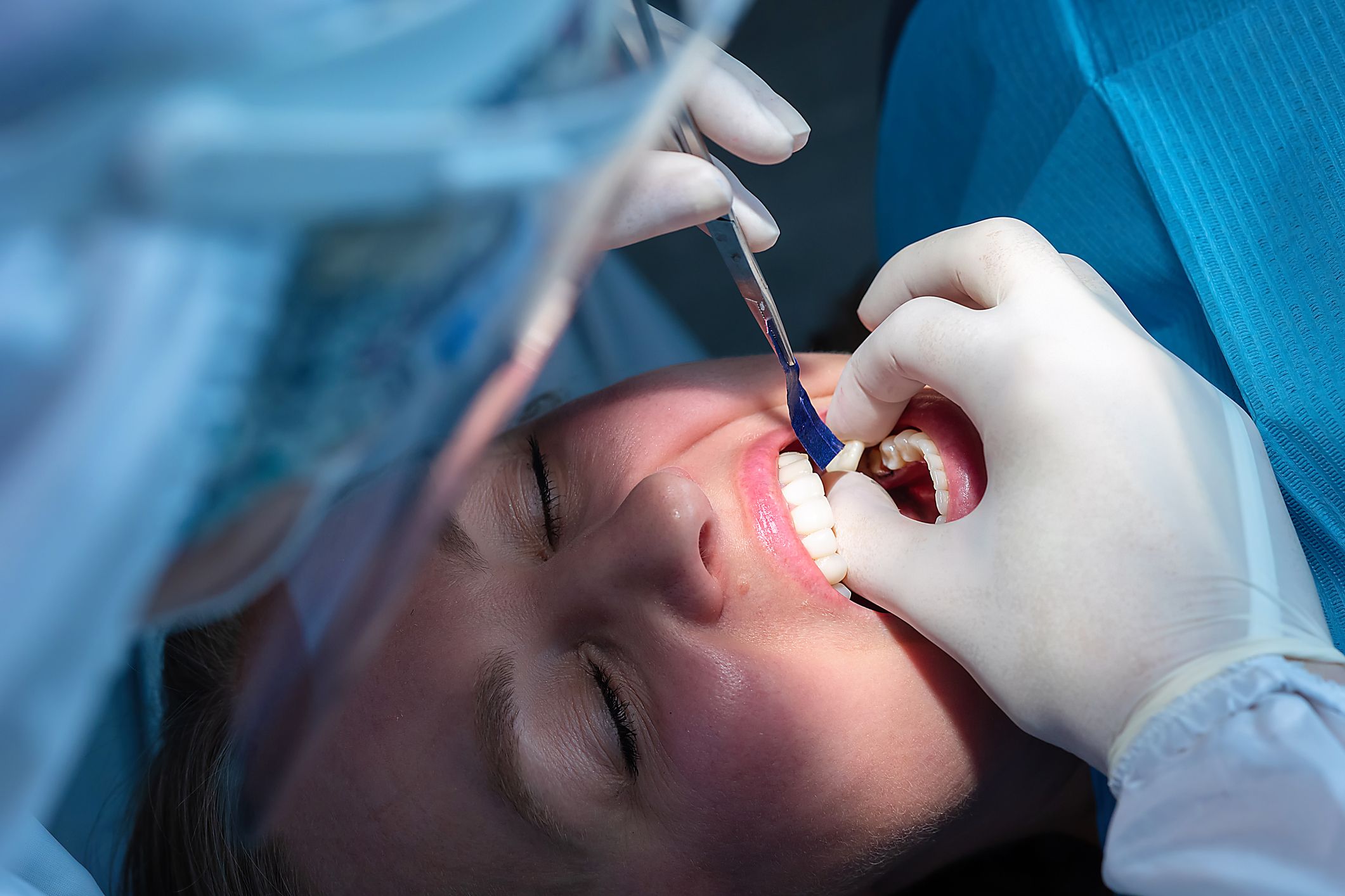Dental Crowns & Bridges