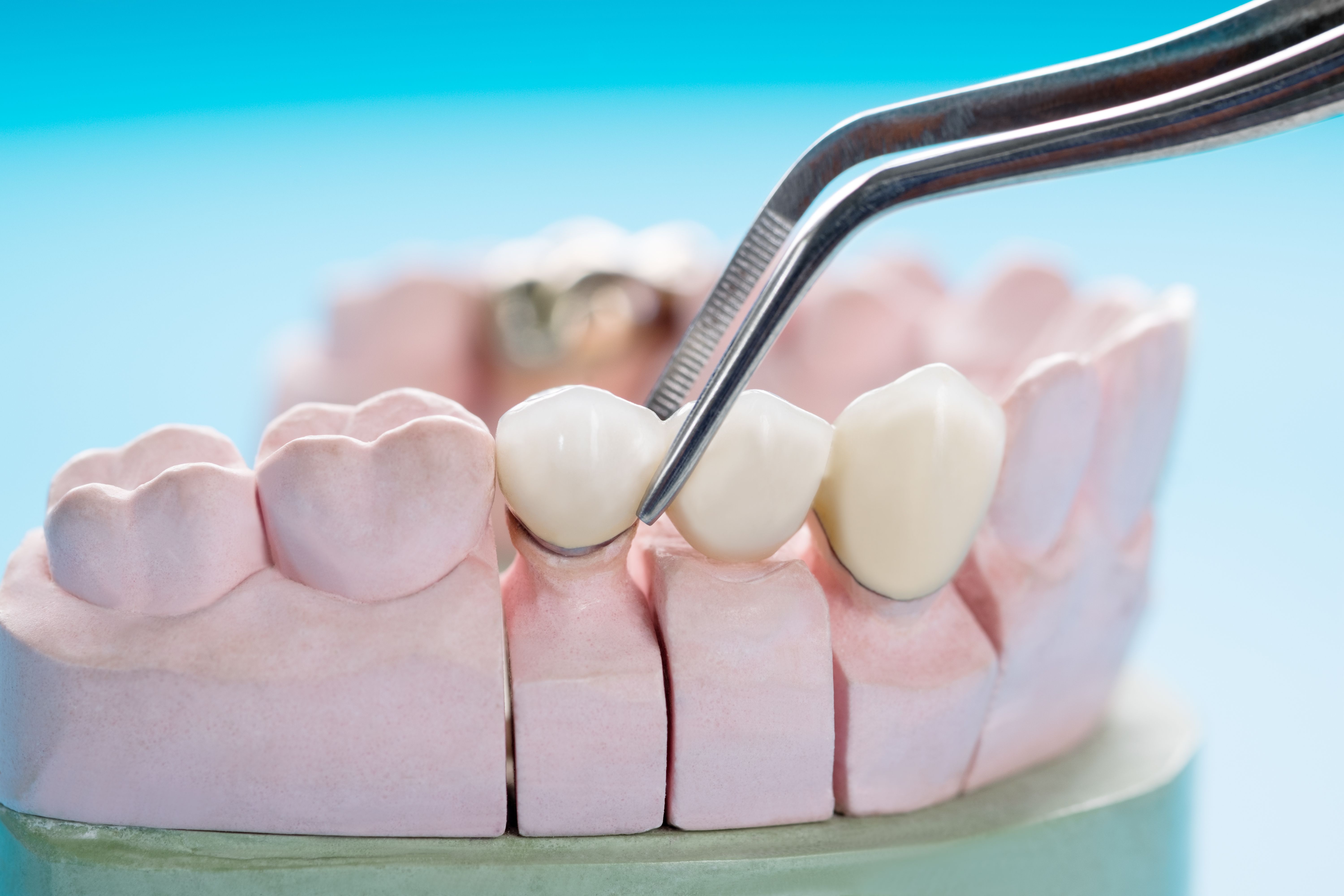 Image of a jaw plastic model and how teeth implants sit on the jaw.
