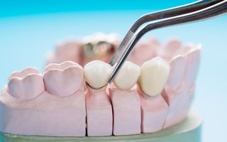 Image of a jaw plastic model and how teeth implants sit on the jaw.