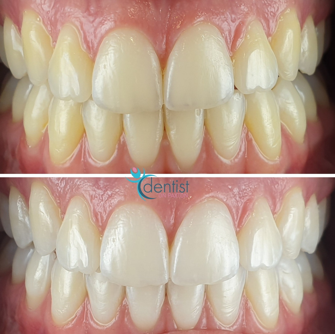 The Benefit of a Brighter Smile - Fast and Effective
