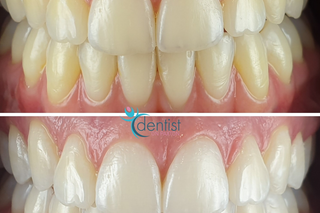 The Benefit of a Brighter Smile - Fast and Effective