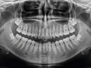 Dental Xray