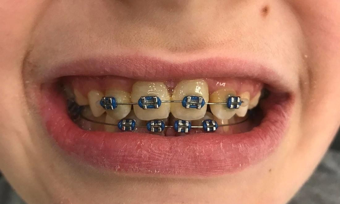 Braces and Invisalign - After