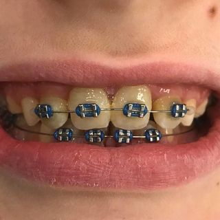 Braces and Invisalign - After