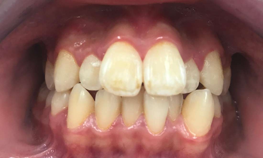 Braces and Invisalign - Before
