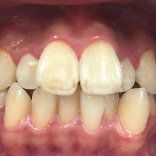 Braces and Invisalign - Before