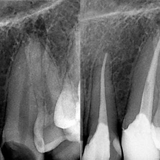 What Causes a Tooth to Need Root Canal Treatment?