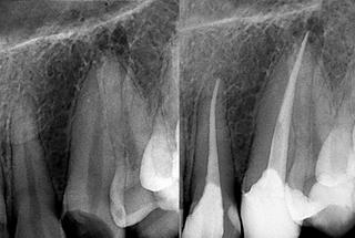 Root canal treatment