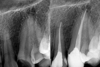 What is a root canal?