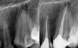 Before and after imaging of Endo treatment