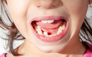 Here are some signs that you might need braces: