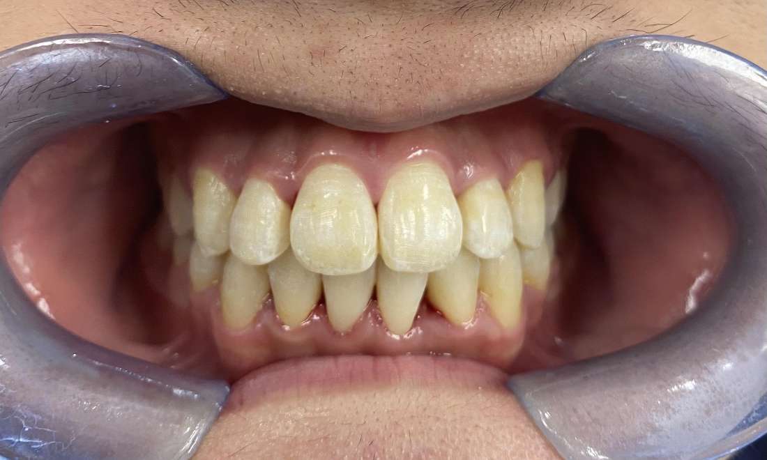Braces and Invisalign - After