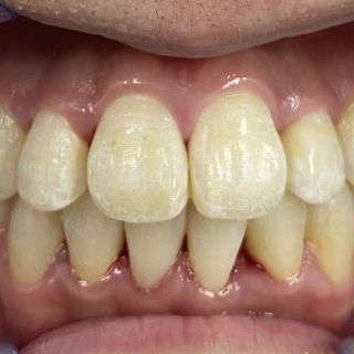 Braces and Invisalign - After