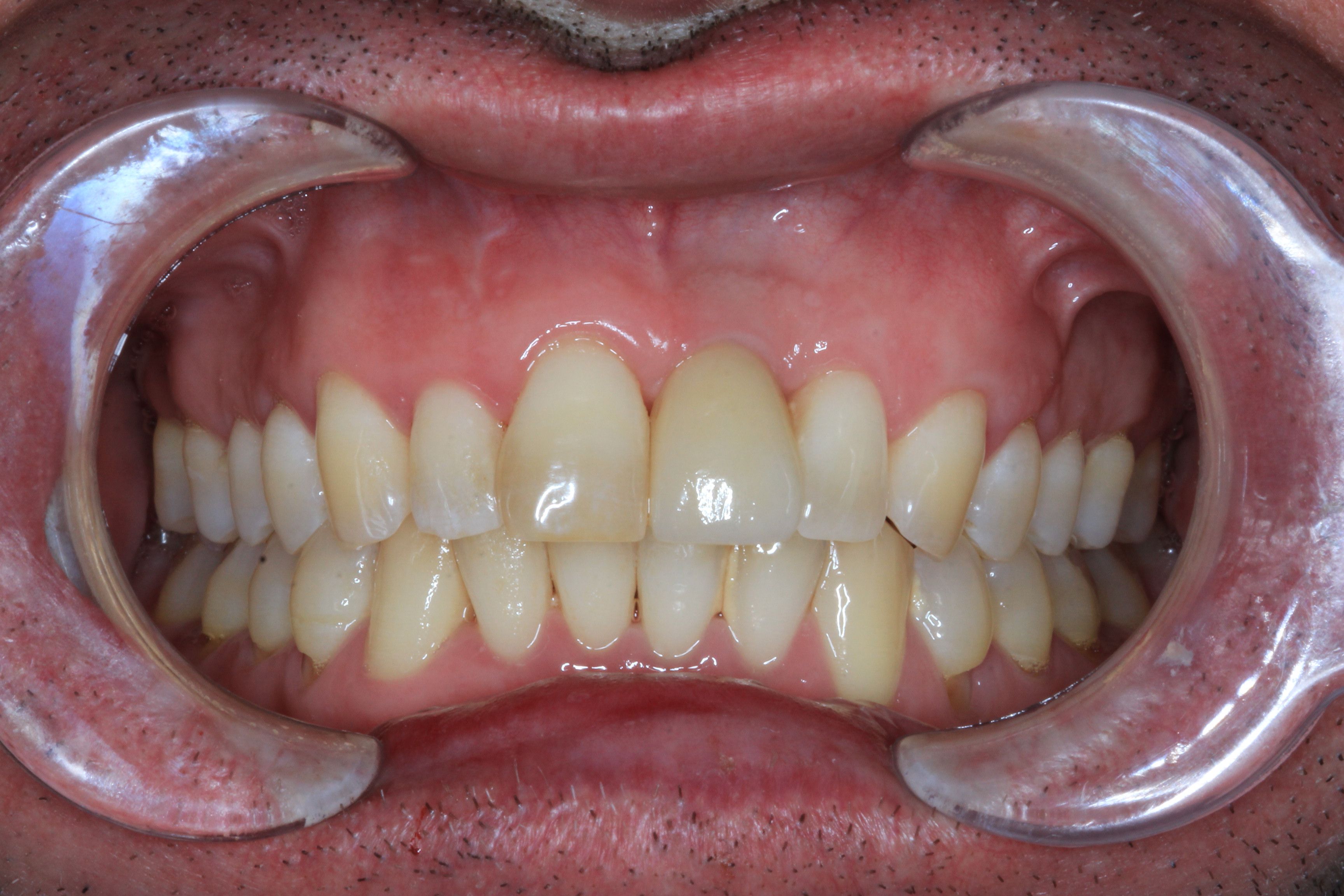 Implant and Root coverage surgery after