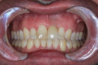 Implant and Root coverage surgery after