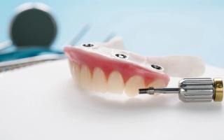 All-On-4® Dental Implants - Hero