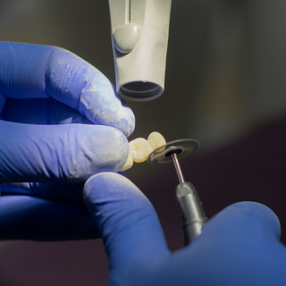Dental Crowns and Bridges at Ranford Road Dental Centre.