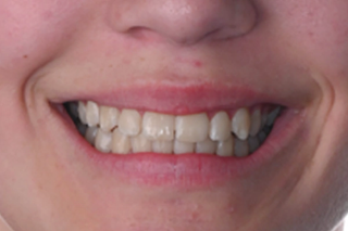 Mal Occlusion treatment - after