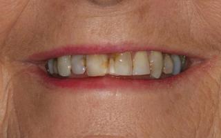 Veneers transformation 001 (before)