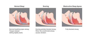 There are three major types of sleep apnoea, which are: