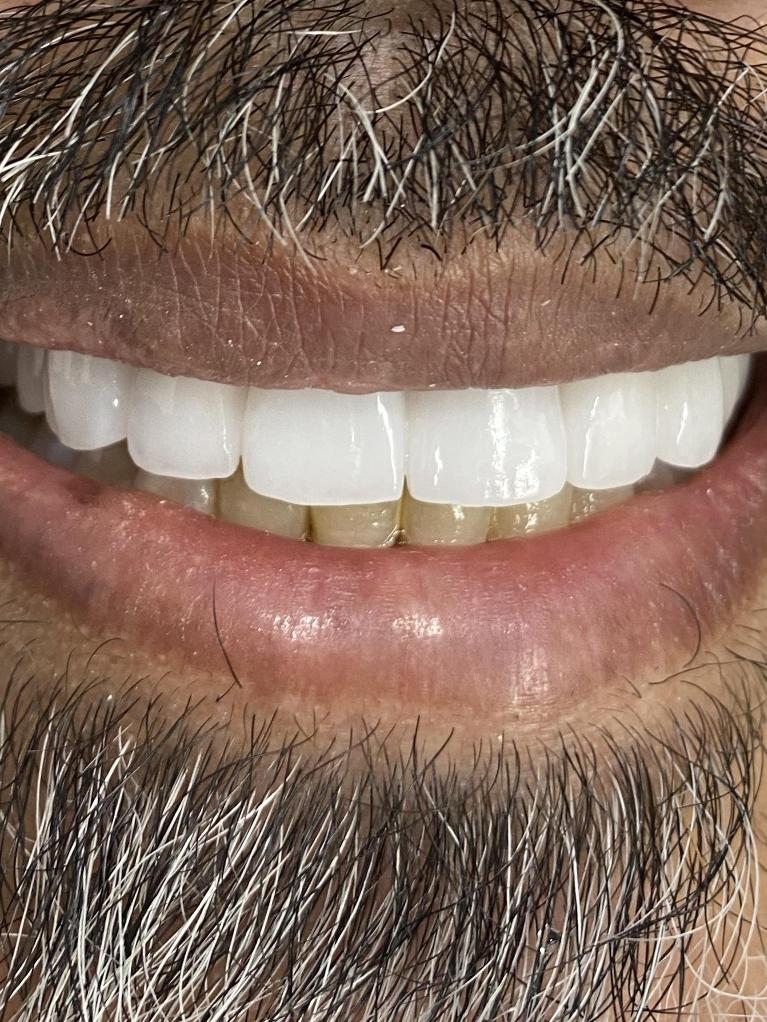 Cosmetic Dentistry - After