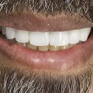 Cosmetic Dentistry - After