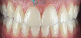After dental veneer