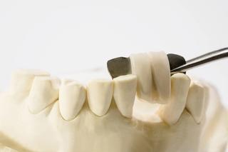 Image of a Maryland bridge on a plastic model of a jaw.