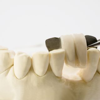 Image of a Maryland bridge on a teeth model.