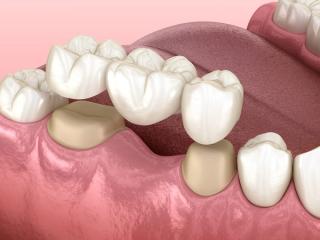 3D render of a jaw with a traditional dental bridge.