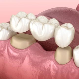 3D render of a tooth supported bridge.