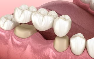 3D render of a dental bridge.