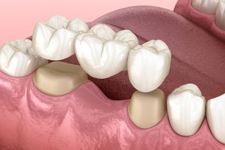 Traditional Dental Bridge