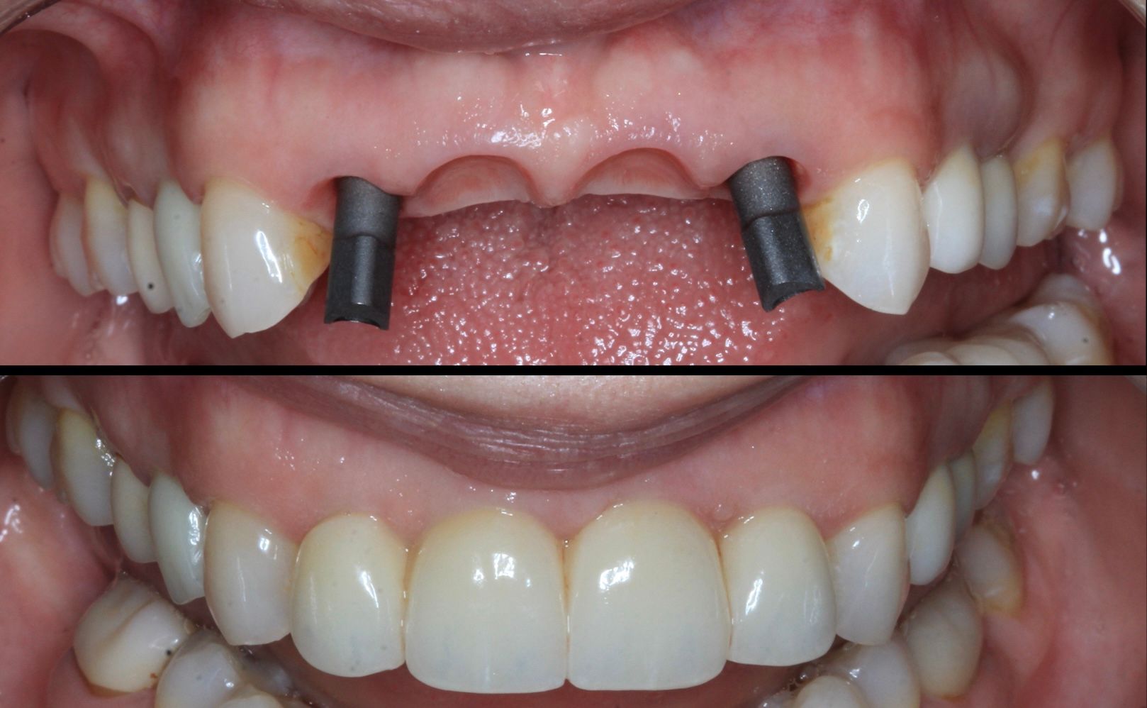 How much does a dental bridge cost?