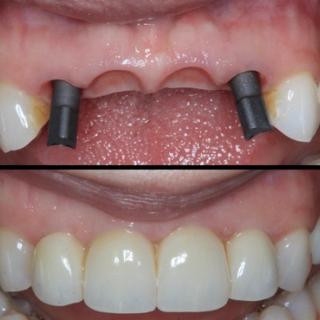How much does a dental bridge cost?