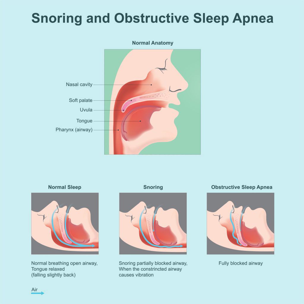 What Is Sleep Apnoea?