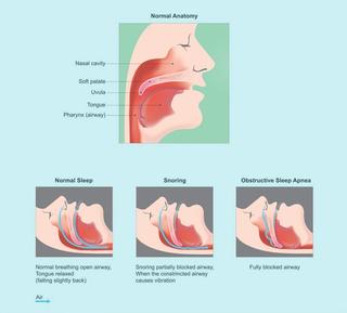 What Is Sleep Apnoea?