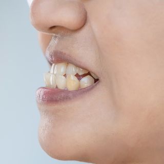 Image of a person with an underbite.